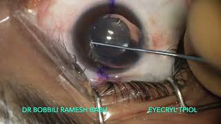 Eyecryl Toric Phakic Intraocular Lens For People Not Suitable For LASER Vision Correction [upl. by Lertsek]