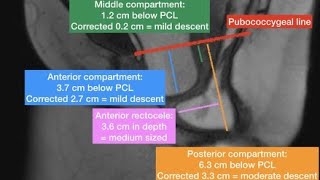 MRI Defecogram Proctogram [upl. by Kaiser299]