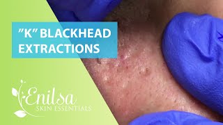 Blackheads Extractions “K’s” 3rd Treatment [upl. by Aij]