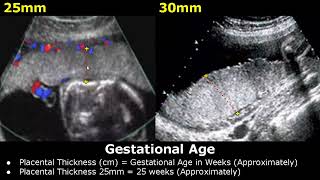 Placental Thickness For Estimating Fetal Gestational Age On Ultrasound  Placenta USG [upl. by Nodearb]