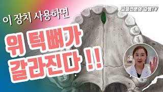 돌출입교정무턱교정주걱턱교정등 치아교정시 반드시 필요 할수 있는 악궁확장의 비밀 RPE 의 비밀 확인하세요최초공개악궁확장장치 상악확장장치 [upl. by Hctub304]