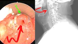 Epiglottitis Emergency Symptoms Causes Treatment [upl. by Ramirolg703]