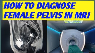 HOW TO DIAGNOSE FEMALE PELVIS FINDING IN MRI MRI FEMALE FIBROID  choclate cyst in mri pelvis [upl. by Erdman784]