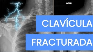 ¿CLAVÍCULA FRACTURADA  Este video es para ti [upl. by Juli]