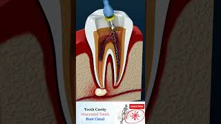 ROOT CANAL TREATMENT Abscess Tooth  Cavities  endodontics  RCT [upl. by Brockie73]