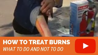 How To Treat Burns 2nd degree 3rd degree burns [upl. by Nanine]