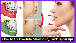 7 Steps How to Fix Overbite small chin big thick upper lip without braces naturally [upl. by Echo]