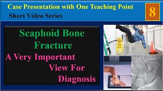 Scaphoid Bone Fracture Case Presentation with One Teaching Point [upl. by Ettedualc]