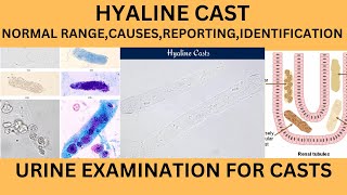 HYALINE CASTS IN URINECAUSES SYMPTOMS TREATMENT OF HYALINE CASTS IN URINE EXAMINATION IN HINDI [upl. by Ynettirb29]