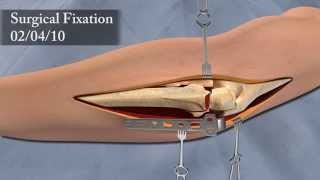 3D Surgical Animation of Elbow Injury [upl. by Darrej]