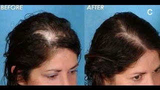 Alopecia Areata Hair loss treatment for women Minoxidil Provillus Review [upl. by Aimaj593]