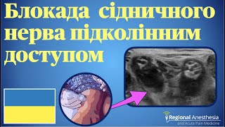 Блокада сідничного нерва підколінним доступом 🇺🇦 Popliteal Sciatic Nerve Block [upl. by Iey]