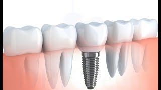 implant tedavisinin detaylı aşamaları 2 diş için [upl. by Ehttam]