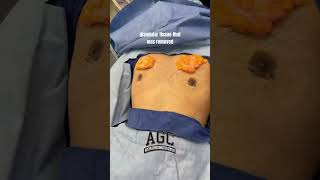 Gynecomastia surgery day of results drcaridi menshealth chestworkout chestfat [upl. by Morganne]