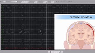 EEG of a Patient With Subdural Hematoma [upl. by Rosie182]