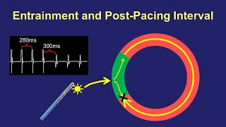 Entrainment Mapping The PostPacing Interval [upl. by Cormack]