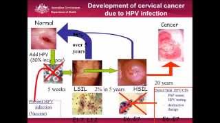 PAP SMEAR TEST PAANO GAGAWIN MASAKIT BA  Shelly Pearl [upl. by Dora]