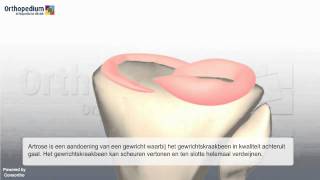 Halve knieprothese  Orthopedium kliniek [upl. by Zailer]