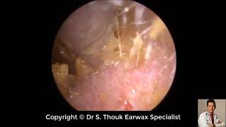 Top Biggest Ear Wax Removal 86  Ear wax Extraction  Dr S Thouk Earwax Specialist [upl. by Jak]