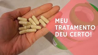 Como ACABEI com a minha Sindrome do Intestino Irritavel  Tratamento NATURAL [upl. by Jsandye]