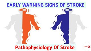 StrokeEARLY WARNING SIGNS OF STROKEPathophysiology Of StrokeMedications In Ischemic Stroke [upl. by Aimek]