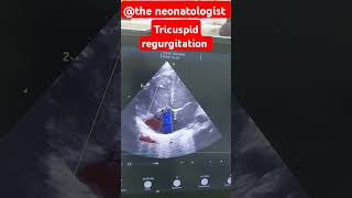 Tricuspid regurgitation neonate echo neonates neonatology echo [upl. by Tirb]