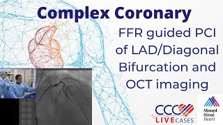 FFR guided PCI of LADDiagonal Bifurcation and OCT imaging  CCC Live April 2016 [upl. by Leasia]