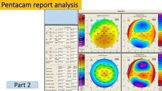 Pentacam report analysis [upl. by Nada]