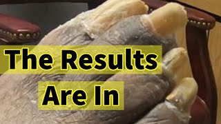 The Results Are In Treatment And Lab Results For Thick Fungal Toenails [upl. by Emyaj]