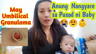 Umbilical Granuloma Treatment Home Remedies Mommyampbaby Vlog  Shelly Pearl [upl. by Ytrebil]