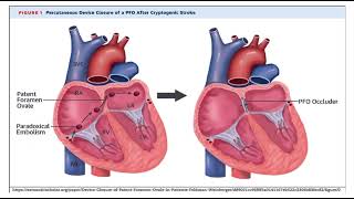 Paradoxical embolism pathology mbbs [upl. by Kitti]