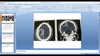 5 Parasagittal meningioma [upl. by Adnowal396]