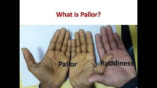 What is Pallor in Medicine  Where to Look for Pallor [upl. by Adiraf63]