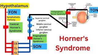 Clinical Case Study Horners Syndrome and Pancoast Tumor [upl. by Kinimod675]