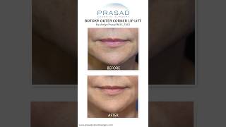 How the Botox Lip Lift Works smile [upl. by Windsor140]