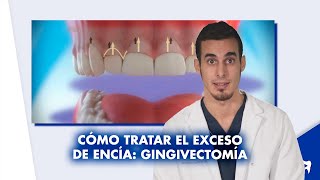 Qué es la SONRISA GINGIVAL y cómo se corrige  Shorts [upl. by Hugo424]