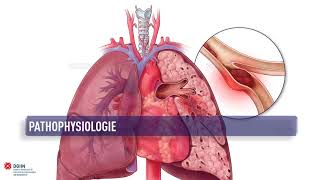 ESC Lungenembolie Leitlinie 2019 Epidemiologie prädisponierende Faktoren Pathophysiologie [upl. by Oirramed]