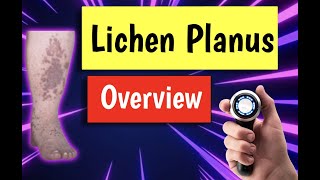 Lichen planus causes treatment diagnosis management [upl. by Rebme]