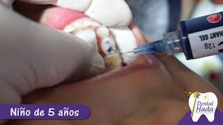 Curaciones dentales en dientes de leche [upl. by Egerton]