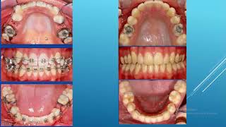 La tecnica de premolares vs tecnica de segundos molares en Ortodoncia [upl. by Dorrie755]