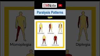 Paralysis or Weakness Patterns [upl. by Eitisahc967]