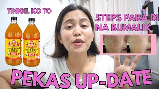 PEKAS O MELASMA UPDATE SECRET PARA DI NA BUMALIKTINIGIL KO NA ANG APPLECIDER VINEGAR [upl. by Yartnoed722]