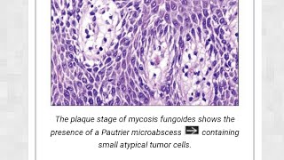 mycosis fungosis [upl. by Alam701]