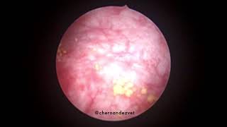 Cystoscopy in a dog with chronic cystitis and multiple calculi [upl. by Clerissa131]