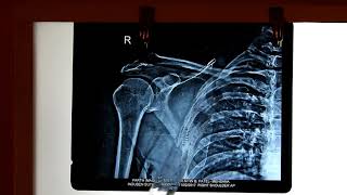 Radiological Anatomy of Upper limb [upl. by Llennor]