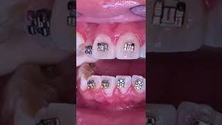 How do they put braces on  10 YEAR old patient  Tooth Time Family Dentistry New Braunfels Texas [upl. by Perice]