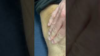 Fluid Bulging from Knee [upl. by Micheal]