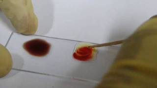 Blood Grouping Experiment  Amrita University [upl. by Nithsa]