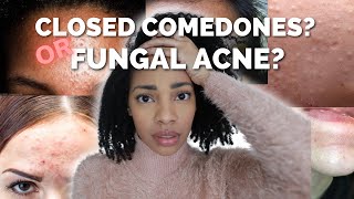 Fungal AcneMalassezia or Closed comedones Heres the difference [upl. by Lilhak]