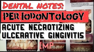 ACUTE NECROTIZING ULCERATIVE GINGIVITIS II PERIODONTOLOGY II DENTAL NOTES II IMPORTANT ANUG [upl. by Montagu]